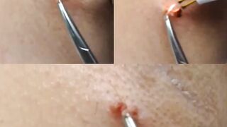 Virtually Painless Skin Tag Removal