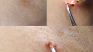 Virtually Painless Skin Tag Removal