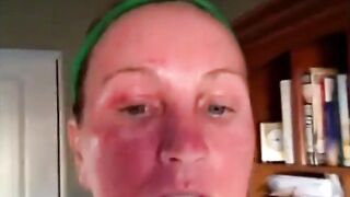 Mixto CO2 Fractional Laser Resurfacing Video Diary