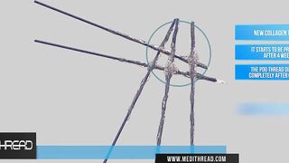 PDO THREAD LIFT TUTORIALS BY MEDITHREAD - 3D CHEEK