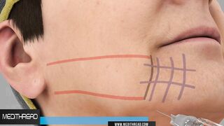 PDO-THREAD LIFT TUTORIALS BY MEDiTHREAD - 3D Jowl