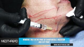 PDO- THREAD LIFT TUTORIAL BY MEDiTHREAD - NECK LIFT