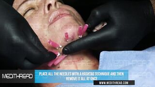 PDO- THREAD LIFT TUTORIAL BY MEDiTHREAD - NECK LIFT