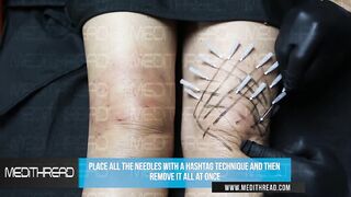 PDO-THREAD LIFT TUTORIAL BY MEDiTHREAD  - KNEE