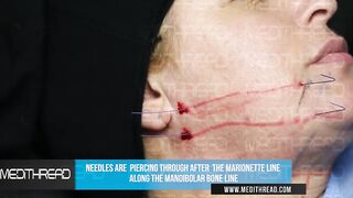 PDO-THREAD LIFT TUTORIAL BY MEDiTHREAD - JAWLINE