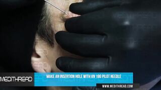 PDO-THREAD LIFT TUTORIAL BY MEDiTHREAD - CHEEK LIFT