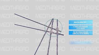 PDO-THREAD LIFT TUTORIAL BY MEDiTHREAD - CHEEK LIFT
