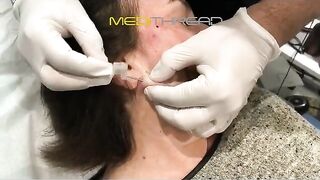 PDO-THREAD LIFT TUTORIAL BY MEDiTHREAD - FULL FACE LIFT AND CONTOUR