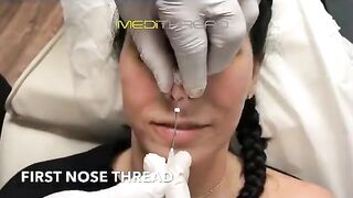 PDO-THREAD LIFT PROCEDURE BY MEDiTHREAD - Nose Lift