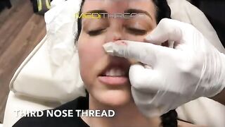 PDO-THREAD LIFT PROCEDURE BY MEDiTHREAD - Nose Lift