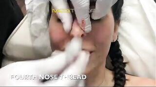 PDO-THREAD LIFT PROCEDURE BY MEDiTHREAD - Nose Lift