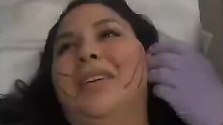 PDO-THREAD LIFT PROCEDURE BY MEDiTHREAD - Cheek Lift