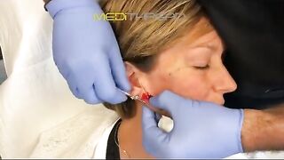 PDO-THREAD LIFT PROCEDURE BY MEDiTHREAD - Cheek Lift, Jawline & Marionette