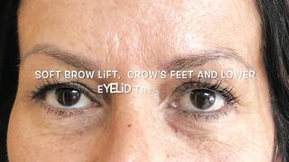 PDO-THREAD LIFT PROCEDURE BY MEDiTHREAD - BROW LIFT  & CROWFEET