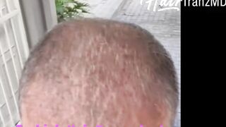 Advanced Turkish Hair Transplant