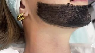 Hollywood Peel (laser carbon peeling) in Beauty Salon "Lisboa Beauty Service"