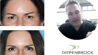Heavy Eyelid Surgery or Blepharoplasty to Remove Extra Skin!!