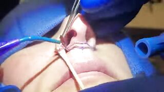 Long/Thin upper lip? Solution: a lip lift. Watch Dr. Diepenbrock and catch a peek at her result!