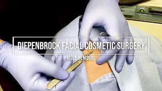 Scarless Mole Removal Using Radiofrequency Energy