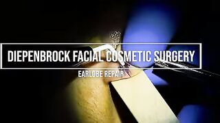 Gauged Ear Repair.  How to Do it with Dr. D
