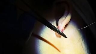 Gauged Ear Repair.  How to Do it with Dr. D