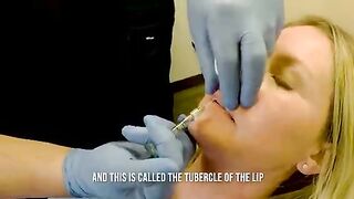 Lip filler before and after - w/ Versa and Restylane Refyne Fort Wayne and Warsaw Indiana