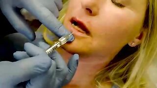 Lip filler before and after - w/ Versa and Restylane Refyne Fort Wayne and Warsaw Indiana