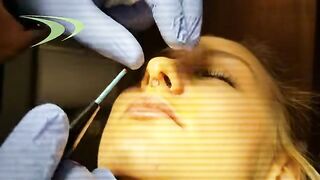Rhinoplasty Scar revision with Ellman Radio Frequency by Cynosure