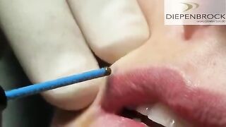 Mole Removal with Ellman RF