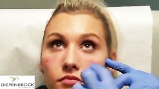 Tear trough fillers by Dr. Diepenbrock Fort Wayne