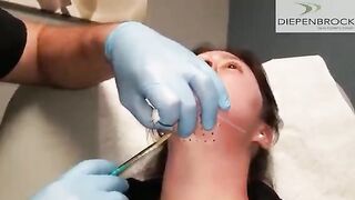 Kybella Injections for Chin and Neck Fullness