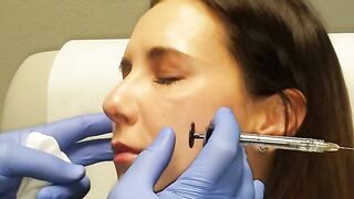 Fuller more beautiful cheeks with Restylane Lyft or Voluma