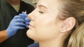 Non-Surgical Nose Job or Non-Surgical Rhinoplasty.  Before and After
