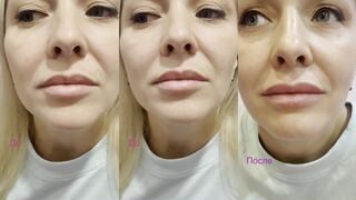 Увеличение губ 💋