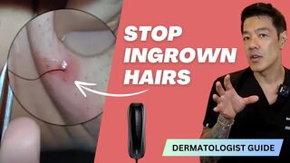 Stop Shaving & Ingrowns | At-Home IPL | Dr Davin Lim