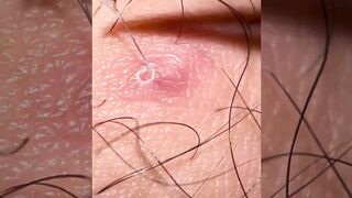 Stop Shaving & Ingrowns | At-Home IPL | Dr Davin Lim
