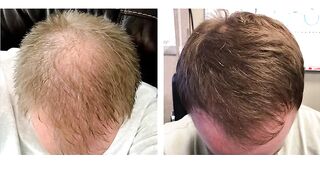 Red Light Therapy: An Adjunct to Minoxidil | Dr Davin Lim