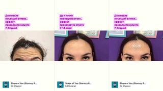Ботулотерапия до и спустя 2 Нед после