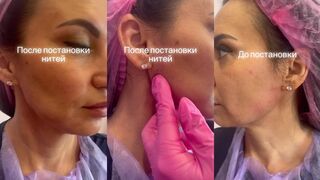 Нити с насечками