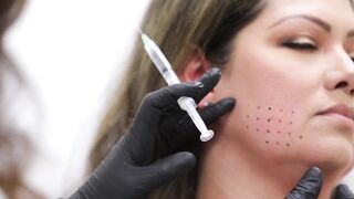 Kybella - Treatment Care