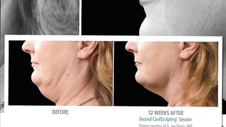 CoolSculpting Skin Perfect Rancho